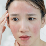 rosacea redness relief with an ipl photofacial near potomac md
